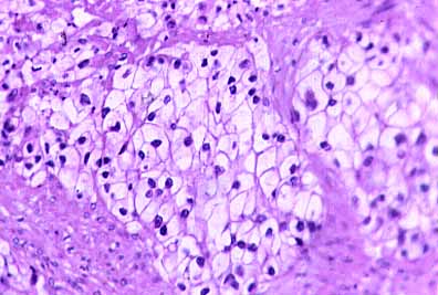Best of Vaginal clear cell carcinoma Gay porn magazine order form gift